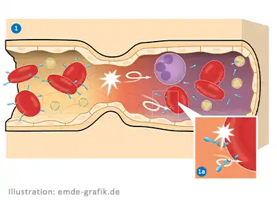 Medical illustration, part 1: Microbiological processes in ischemia (reduced or absent blood flow to the tissue)